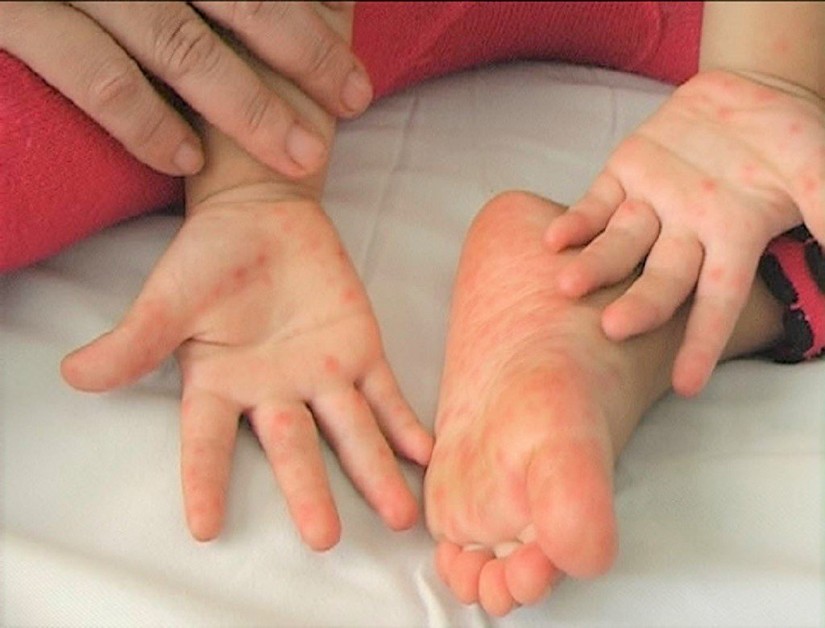 Số ca mắc tăng cao, Bộ Y tế yêu cầu siết chặt phòng chống dịch tay chân miệng