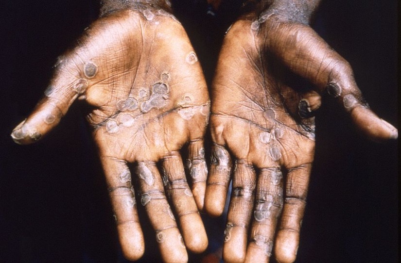 Lòng bàn tay của một bệnh nhân sau khi mắc bệnh đậu mùa khỉ ở Cộng hòa Congo, 1997. Ảnh: Reuters