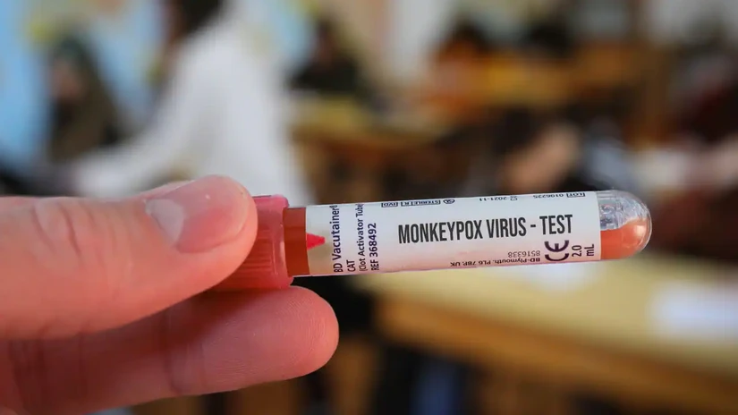 Một mẫu xét nghiệm virus đậu mùa khỉ. Ảnh: Nation World News 