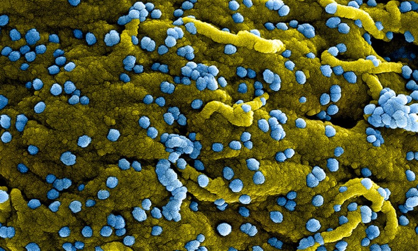 Hình ảnh các hạt virus Marburg (màu xanh lam) dính trên bề mặt của các tế bào VERO E6 bị nhiễm bệnh (màu vàng). Ảnh: Getty Images